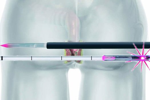 Νέα ενδοσκοπική θεραπεία με LASER δίνει τέλος στην κύστη κόκκυγος.