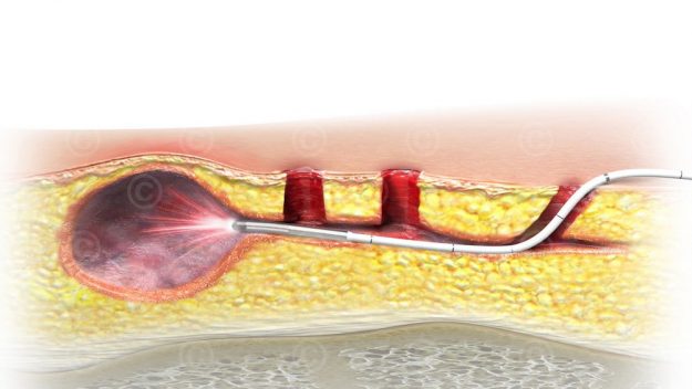 Κύστη Κόκκυγος Κύστη Κόκκυγος