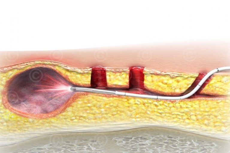 Κύστη Κόκκυγος