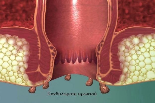 Κονδυλώματα HPV