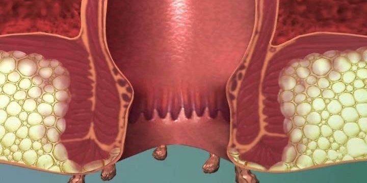 Κονδυλώματα HPV Κονδυλώματα HPV