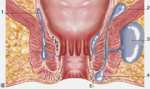 Περιεδρικό Συρίγγιο – Απόστημα Πρωκτού Περιεδρικό Συρίγγιο – Απόστημα Πρωκτού