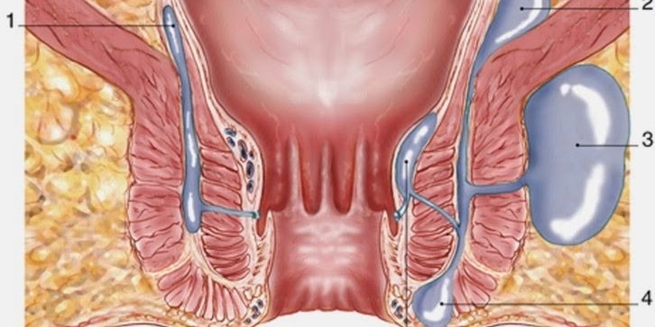 Περιεδρικό Συρίγγιο – Απόστημα Πρωκτού Περιεδρικό Συρίγγιο – Απόστημα Πρωκτού