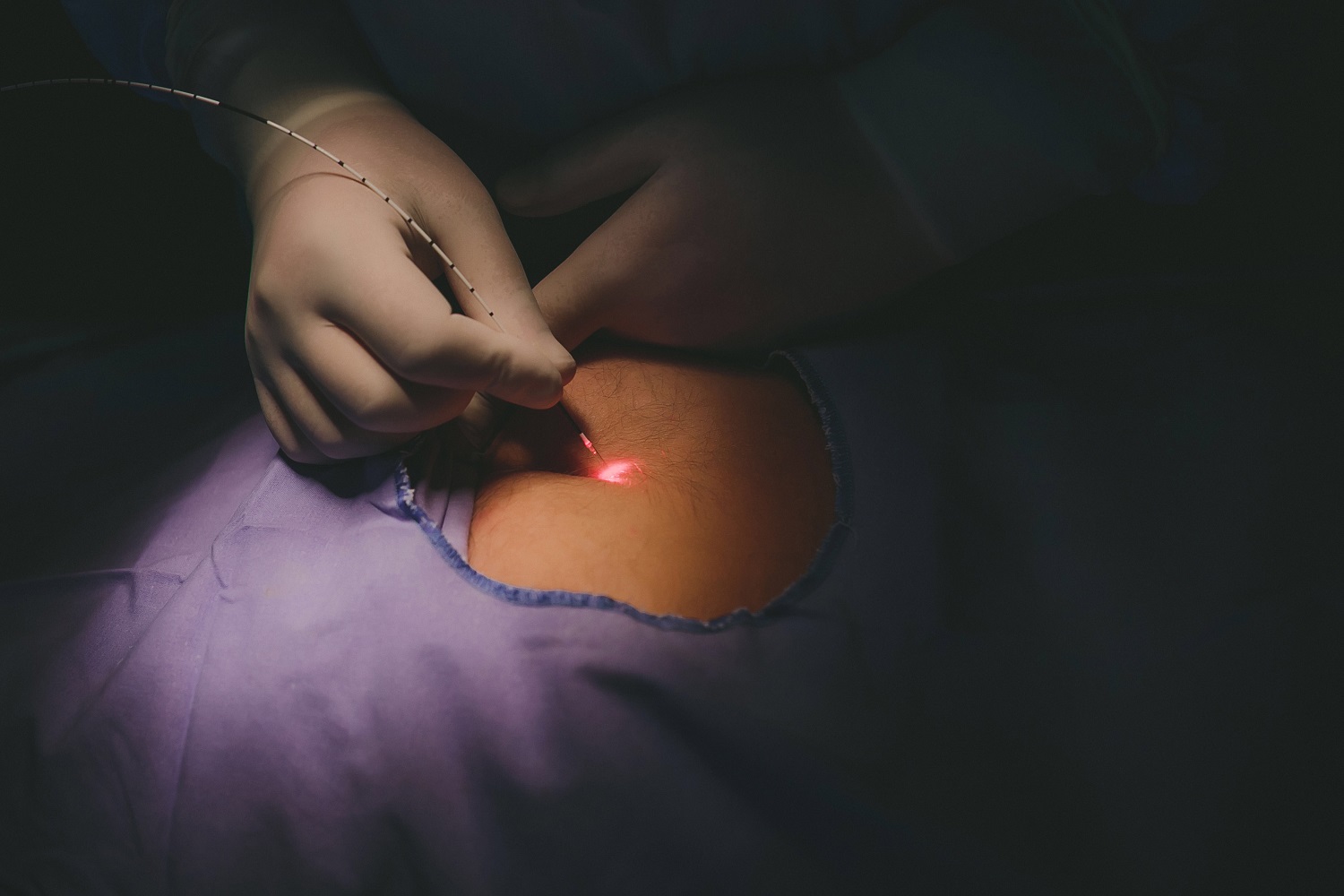 Αιμορροιδες Laser Θεραπεία
